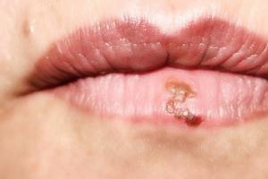 Вы точно знаете, почему шелушатся губы?
